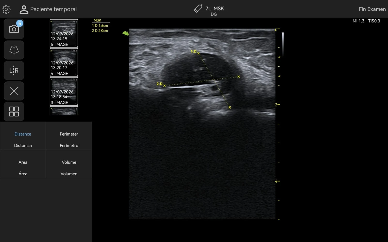 Ultrasonido de quiste parameniscal lateral