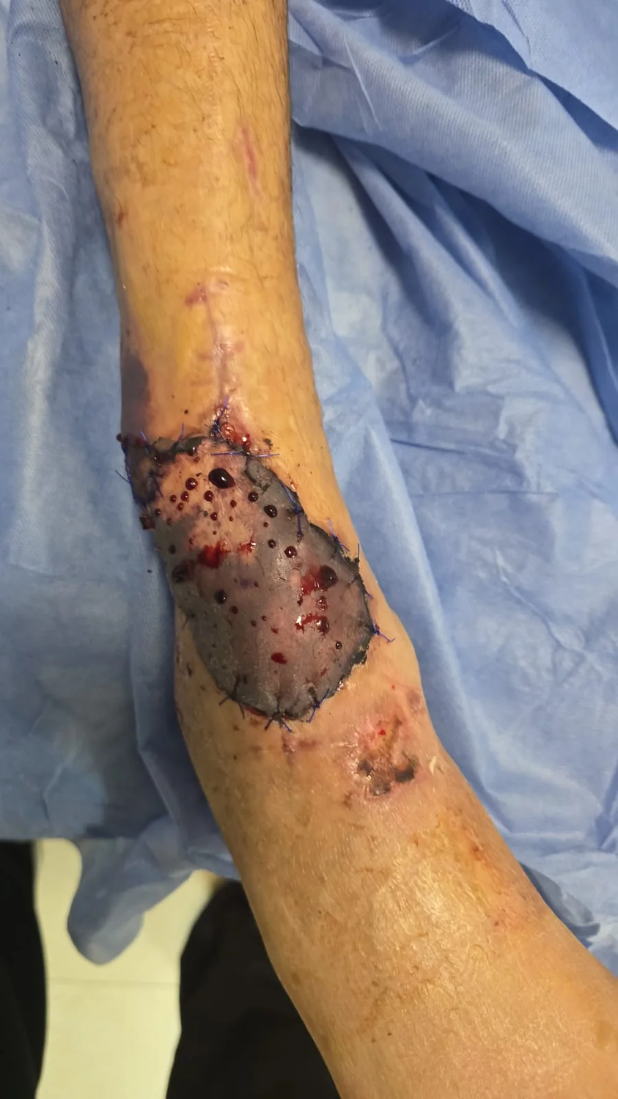 Aspecto postoperatorio de la reconstrucción